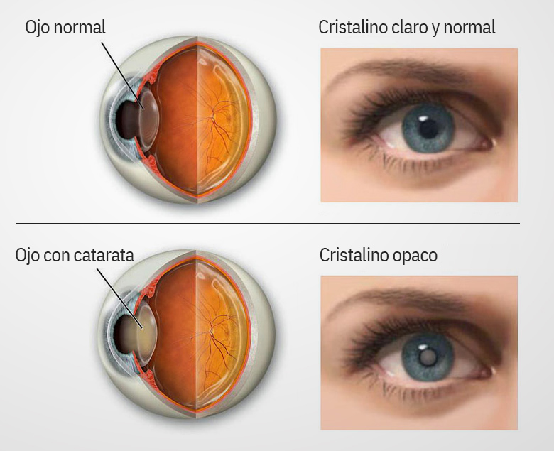 Catarata en el cristalino